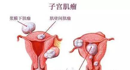 宫腔镜检查_什么情况做宫腔镜检查_宫腔镜检查后