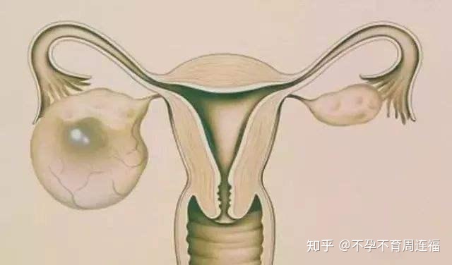 多囊卵巢怀孕几率_多囊卵巢_多囊卵巢综合症怀孕