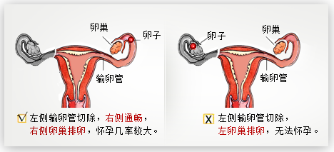 多囊卵巢综合症怀孕_多囊卵巢怀孕几率_多囊卵巢