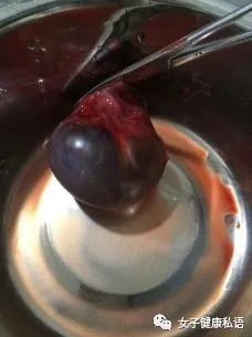 脚踝 囊肿 微波理疗仪 治疗囊肿_巧克力囊肿_囊肿巧克力 囊肿