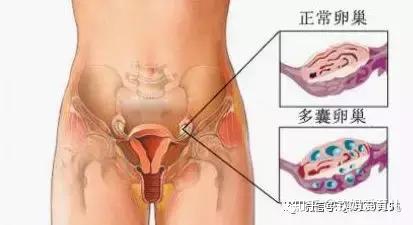 巧克力囊肿