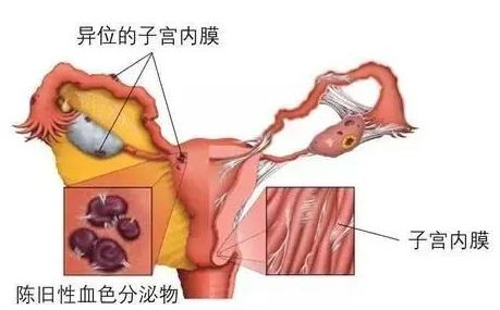 脚踝 囊肿 微波理疗仪 治疗囊肿_巧克力囊肿_囊肿巧克力 囊肿