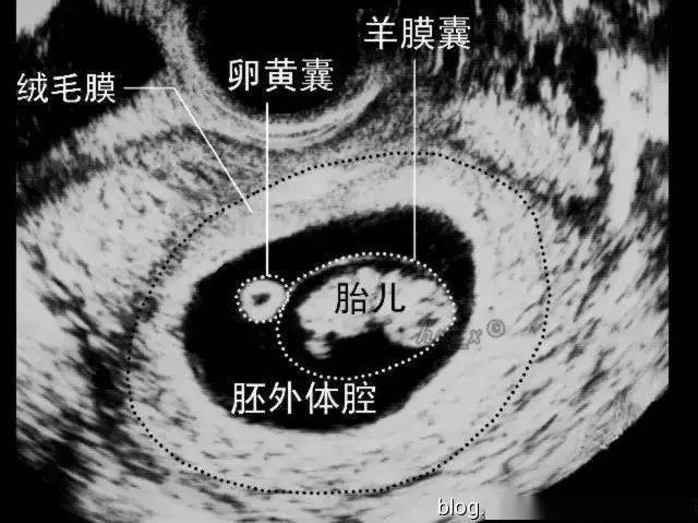 同卵双胞胎_同卵双胞胎和异卵双胞胎_同卵与异卵双胞胎