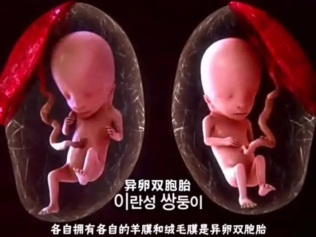 同卵双胞胎_同卵和异卵双胞胎_同卵与异卵双胞胎