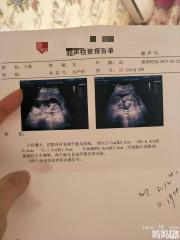 同卵双胞胎