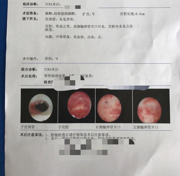 宫腔粘连