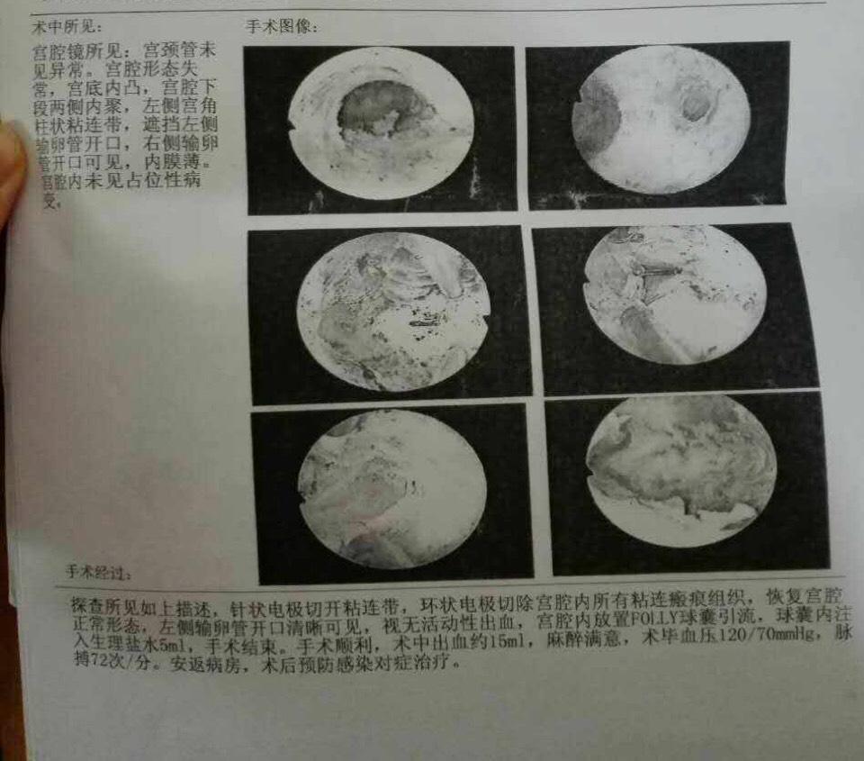 宫腔粘连