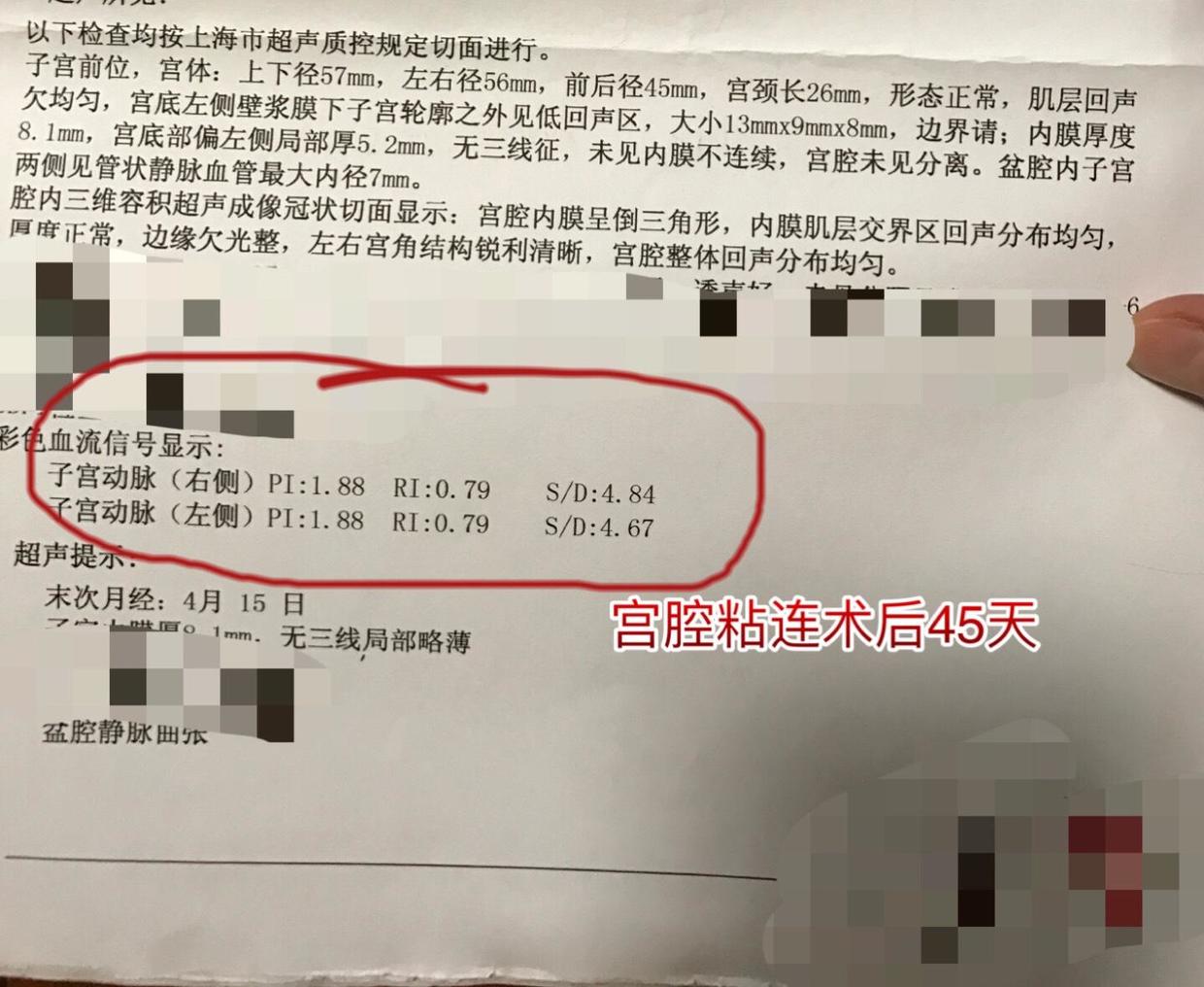 宫腔粘连