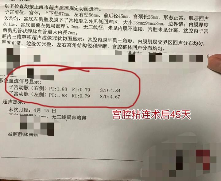宫腔粘连