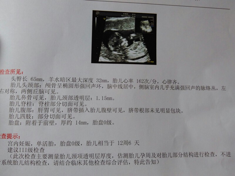 唐氏综合症_唐氏综合筛查是什么_唐氏筛查综合值是1::425,参考值是1:250