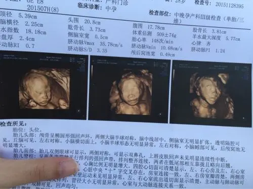唐氏综合筛查是什么_唐氏筛查综合值是1::425,参考值是1:250_唐氏综合症