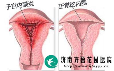 子宫没有内膜有月经吗_内膜正常子宫会粘连_子宫内膜薄