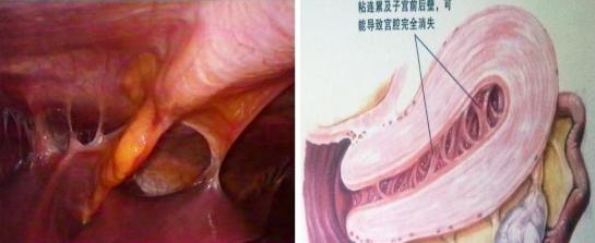 宫颈内口粘连_宫腔粘连_我的第二次剖宫粘连的肠子掰开