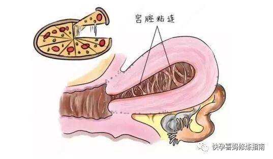 宫颈内口粘连_宫腔粘连_我的第二次剖宫粘连的肠子掰开
