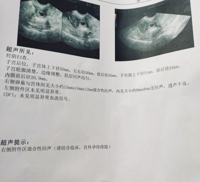 造影可以疏通输卵管吗_输卵管造影_造影疏通输卵管吗