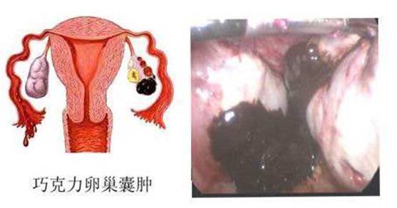 巧克力 囊肿_巧克力囊肿_双肾多发囊肿左侧伴钙囊肿