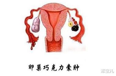 巧克力囊肿_双肾多发囊肿左侧伴钙囊肿_巧克力 囊肿