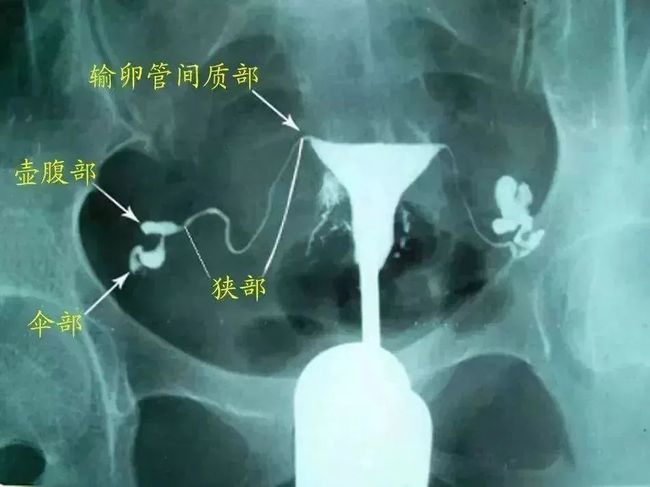 怎么做输卵管超声造影_输卵管造影_输卵管b超造影和x造影
