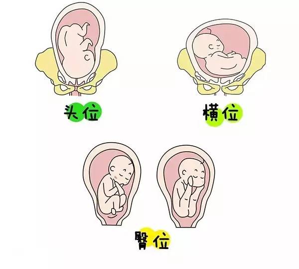 多胎妊娠减胎术_妊娠剧吐每胎都那样吗_多胎妊娠
