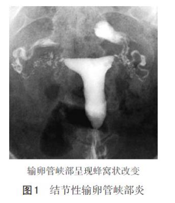 输卵管造影