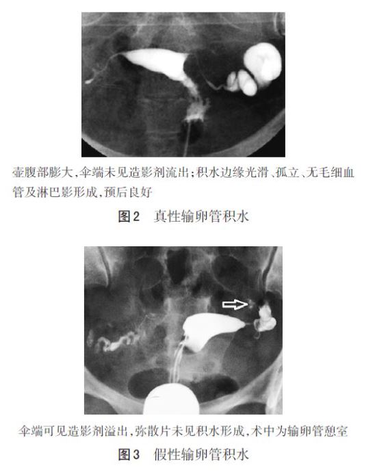 输卵管造影
