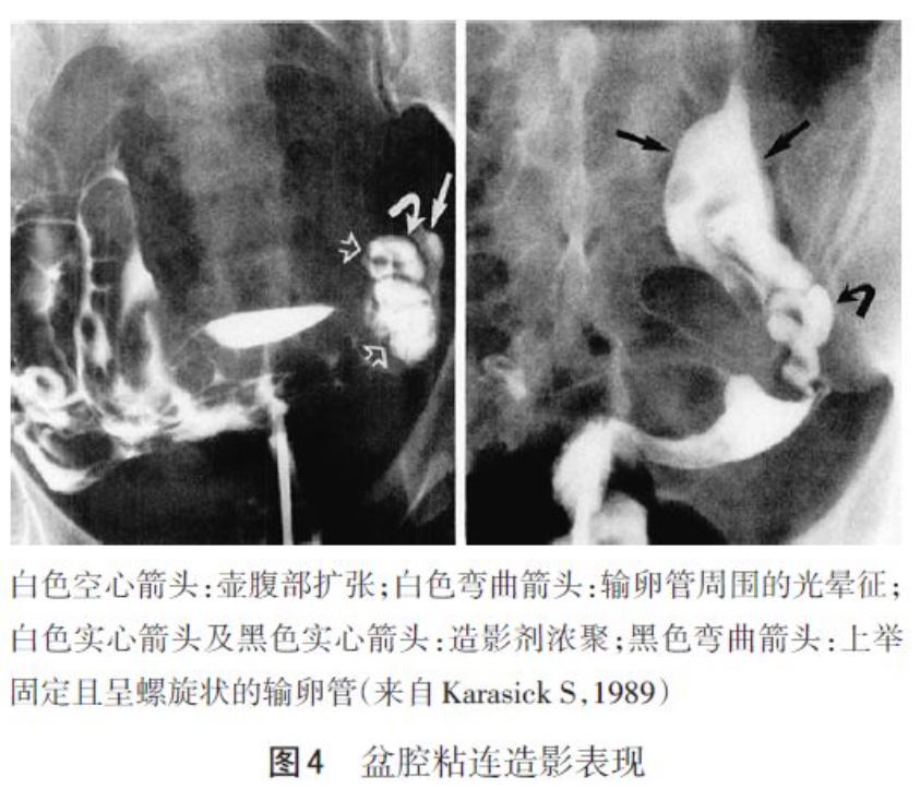 输卵管造影