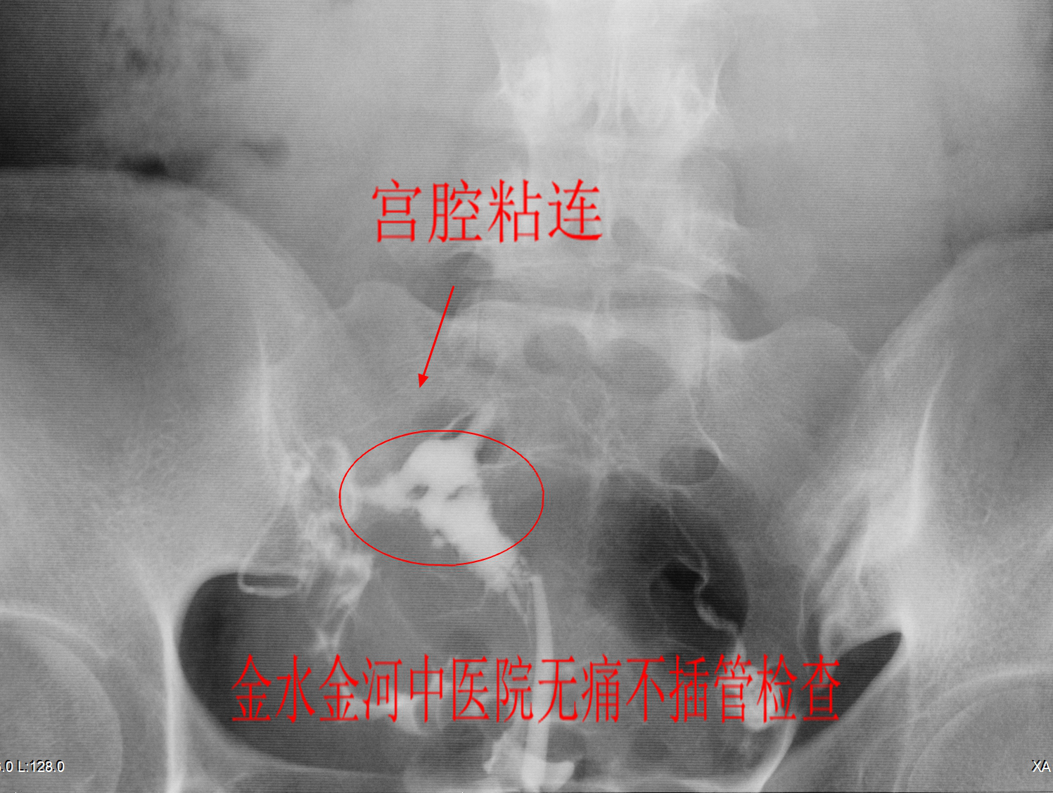 什么是宫腔镜检查_宫腔镜检查后_宫腔环境检查