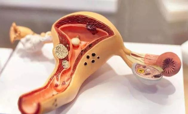 子宫腺肌症