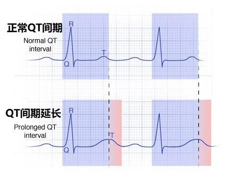 长QT间期综合征