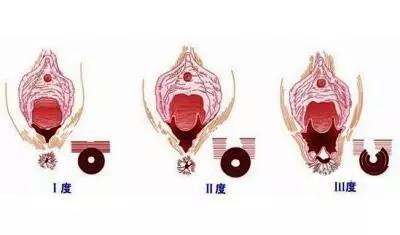 侧切伤口发炎怎么办_侧切_顺产 侧切