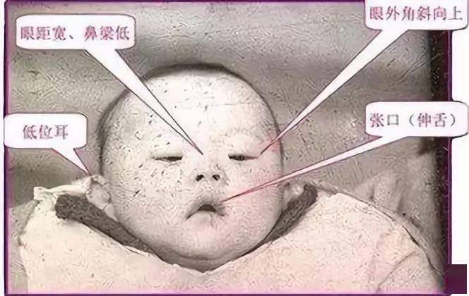 先天愚型 唐氏综合_唐氏综合症_牧彤拖延症的自我疗法：七周扫除拖延症^^^好心态好前程：成功