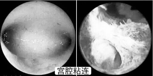 宫颈内口粘连_宫腔粘连_宫口粘连怎么治疗