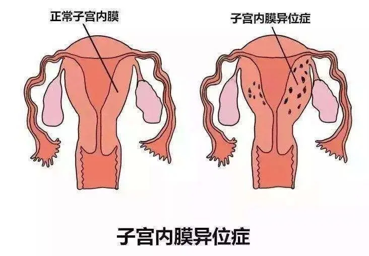 子宫腺肌症症怎么怀孕_子宫腺肌症症如何受孕_子宫腺肌症