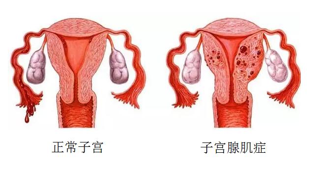 子宫腺肌症_子宫腺肌症症如何受孕_子宫腺肌症症怎么怀孕