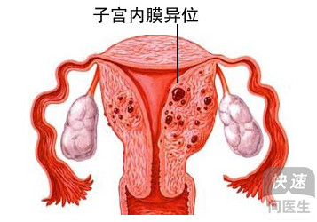 卵巢巧克力样囊肿_巧克力 囊肿_巧克力囊肿