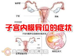 巧克力 囊肿_卵巢巧克力样囊肿_巧克力囊肿