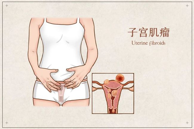 卵巢巧克力样囊肿_巧克力囊肿_巧克力 囊肿