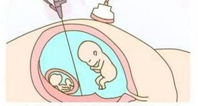多胎妊娠减胎_足月妊娠正常胎心音_多胎妊娠