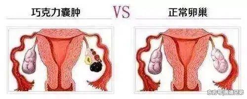 巧克力囊肿_双肾多发囊肿左侧伴钙囊肿_皮样囊肿或皮脂腺囊肿图片