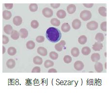 白细胞_线索细胞阳性脓细胞 白带绿色_白纹伊蚊c/细胞
