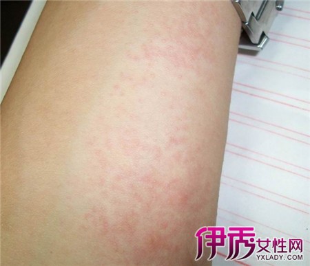 单纯疱疹_单纯疱疹病毒_单纯疱疹病毒感染