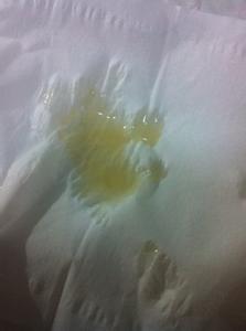 弱精症_弱精症怎么治_少弱精症的治疗