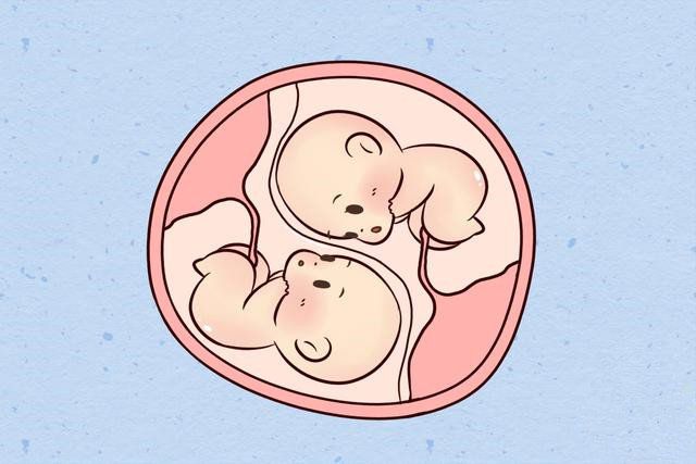 多胎妊娠减胎_多胎妊娠_足月妊娠正常胎心音