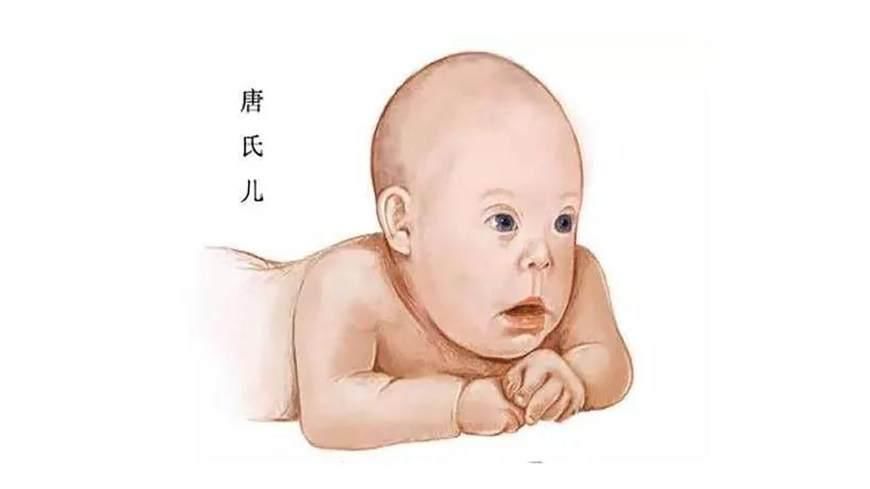 唐氏综合症_唐氏综合筛查是什么意思_囤积症对应的是什么症