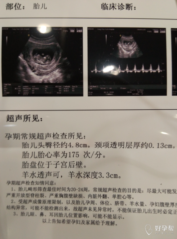 囤积症对应的是什么症_唐氏综合筛查是什么意思_唐氏综合症