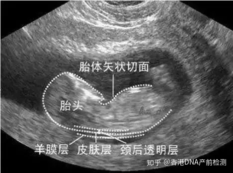 唐氏综合筛查是什么意思_唐氏综合症_囤积症对应的是什么症