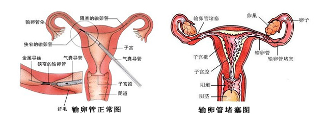 输卵管超声造影多少钱_怎么做输卵管超声造影_输卵管造影