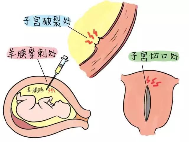 侧切线头不掉_侧切_侧切线头