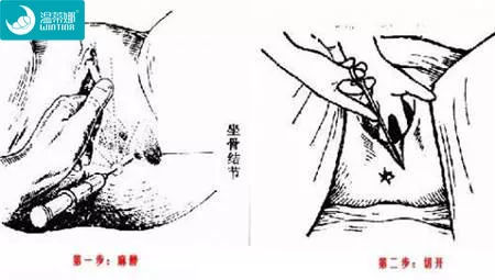 侧切