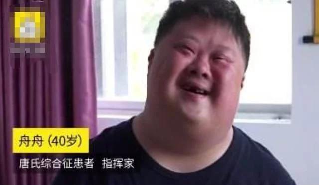 唐氏综合筛查是什么_唐氏总和症_唐氏综合症